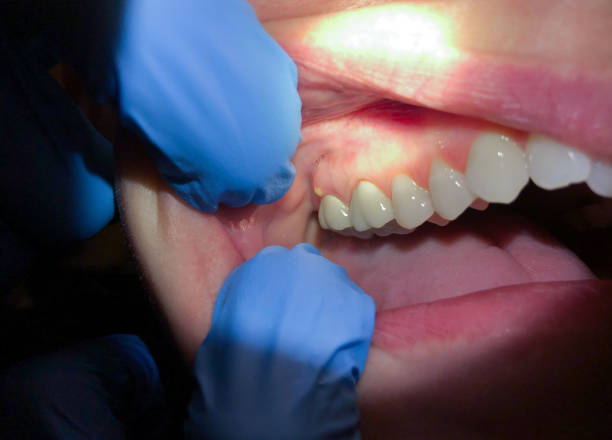 Best Broken or Chipped Tooth Repair in Norton, KS